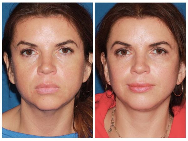 Buccal-Fat-Removal-effect