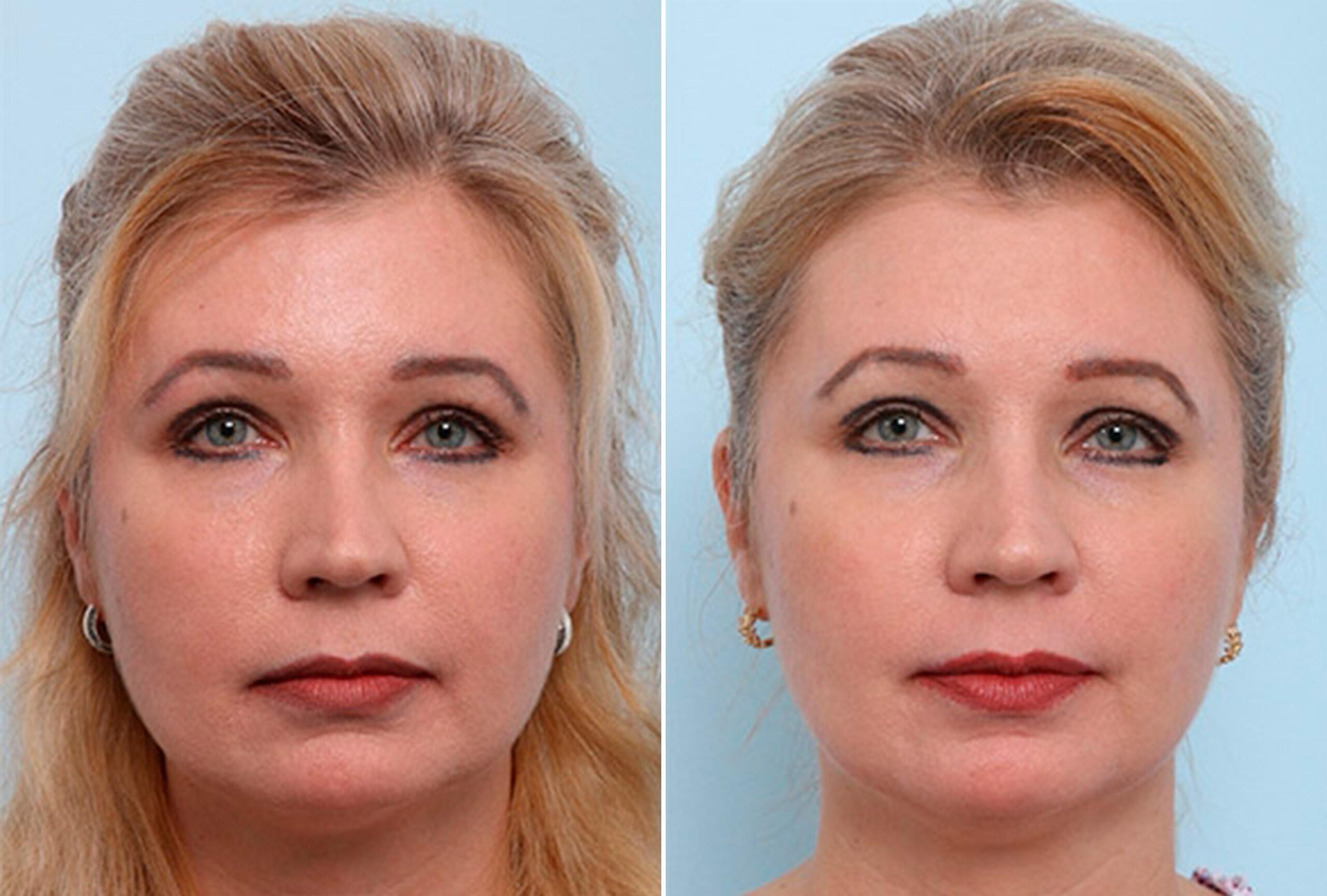 Buccal-Fat-Removal-photo
